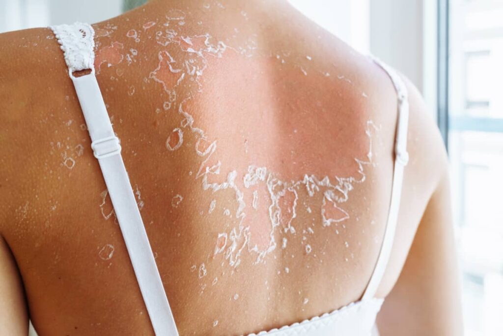 Peut-on bronzer après un pelage et quels sont les risques ?